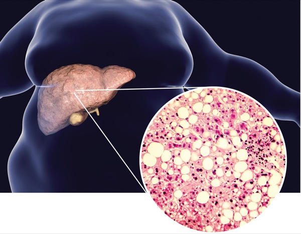 hepatosis máj kezelés cukorbetegség