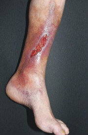 mazi a sebek cukorbetegségével a seb lábakon és a kezelésükön)