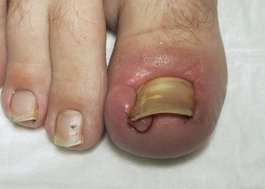 Betegségek körmöket, mert mi is előfordulhat, és más gombás lábujj köröm betegség